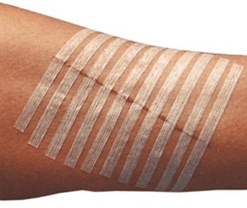 Wound Closure Strips